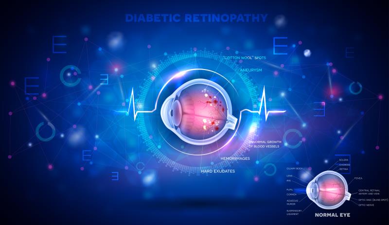 Diabetic retinopathy tied to increased intubation risk in COVID-19