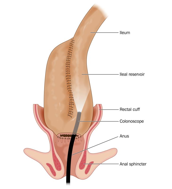 Diffuse inflammation, stapled anastomosis may predict cuffitis risk