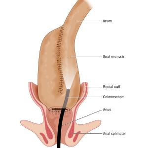 Diffuse inflammation, stapled anastomosis may predict cuffitis risk