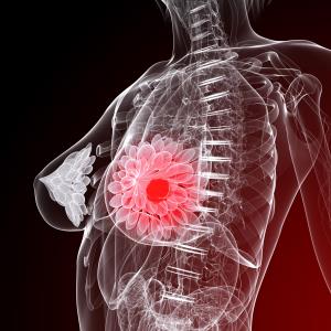 Digital breast tomosynthesis may be better than mammography for breast cancer detection