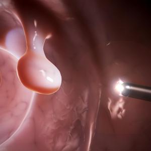 Computer-aided colonoscopy minimizes adenoma miss rate