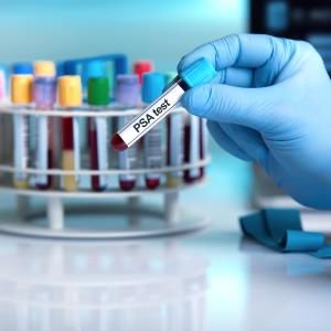 Does statin affect performance of PSA screening?