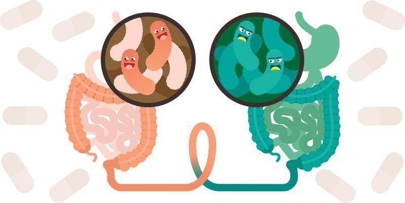 Donor selection for FMT key to sustained UC remission