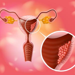 Add-on dostarlimab boosts PFS in endometrial cancer