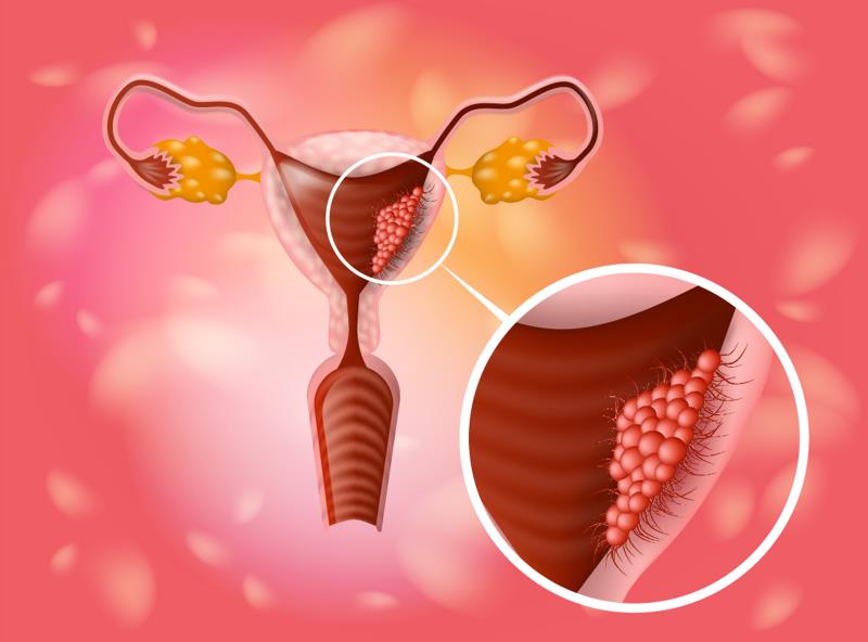 Add-on dostarlimab boosts PFS in endometrial cancer