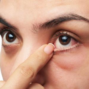 Semaglutide linked to modest increase in risk of nonarteritic anterior ischemic optic neuropathy