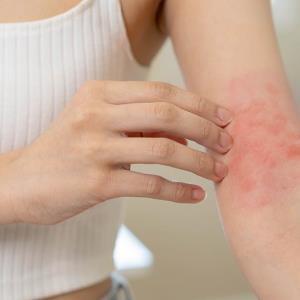 Dupilumab delivers on its promise for Asians with atopic dermatitis