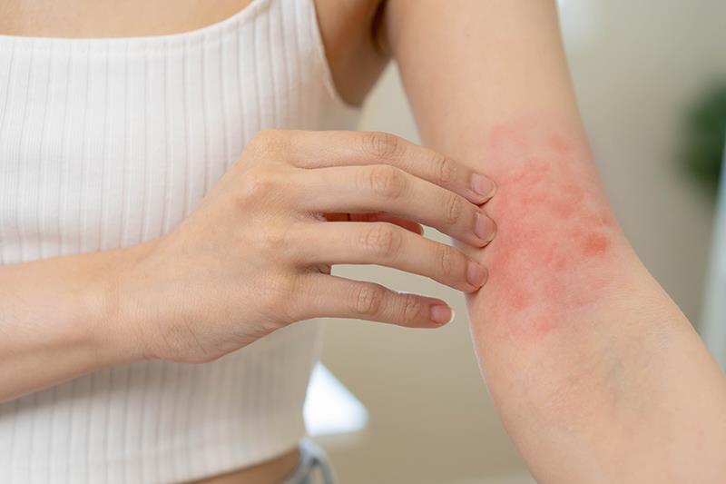 Investigational IL-13 inhibitor shows therapeutic potential in atopic dermatitis