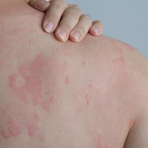Dupilumab eases itch, disease activity in chronic spontaneous urticaria