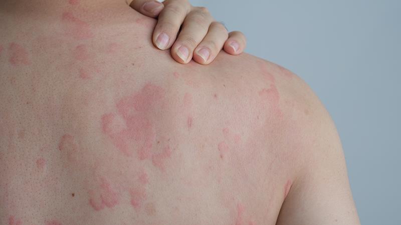 Dupilumab eases itch, disease activity in chronic spontaneous urticaria