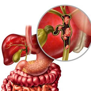 Pembrolizumab plus gemcitabine/cisplatin improves survival in metastatic biliary tract cancer