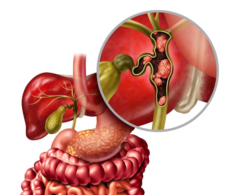 Pembrolizumab kết hợp gemcitabine/cisplatin cải thiện sống còn ở bệnh nhân ung thư đường mật di căn