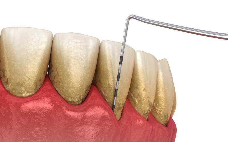 Oral health checks integral to diabetes management