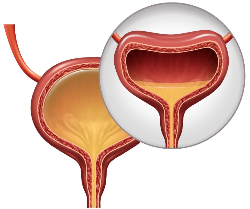 AbobotulinumtoxinA cuts incontinence episodes in patients with NDOI