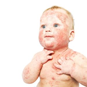 Infantile skin infection ups risk of paediatric psoriasis