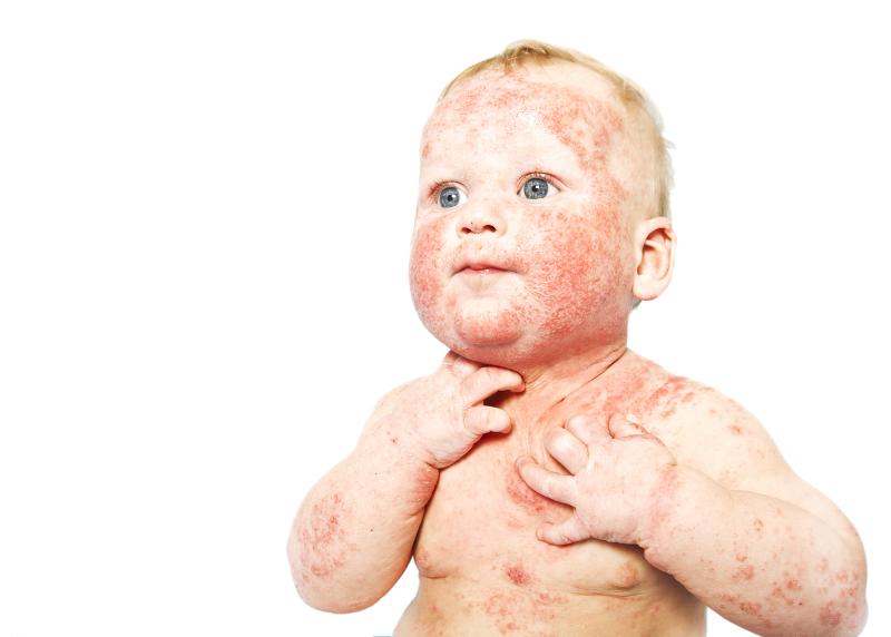 Infantile skin infection ups risk of paediatric psoriasis