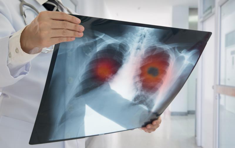 SPOTLIGHT: Durvalumab shines in real-world trial on NSCLC