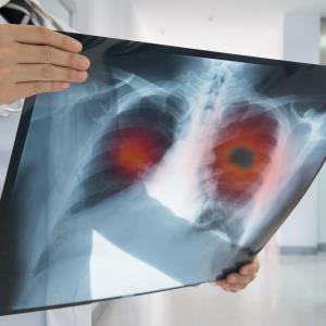 SPOTLIGHT: Durvalumab shines in real-world trial on NSCLC