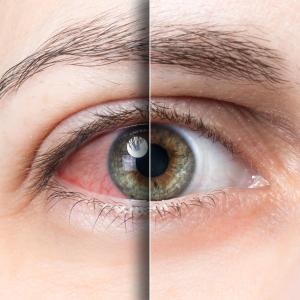 SGLT2 inhibitors potentially protective against dry eye disease