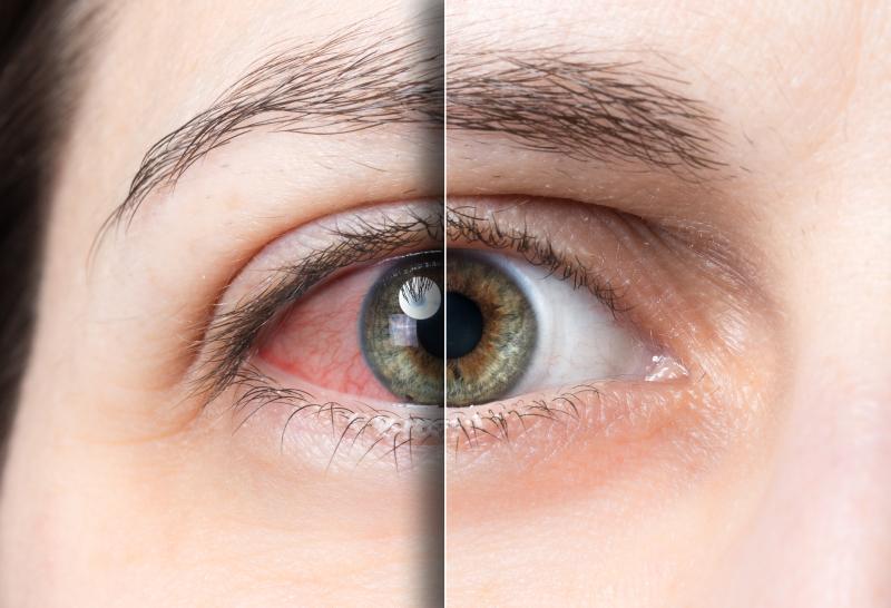 Ocular surface discomfort likely after paclitaxel treatment