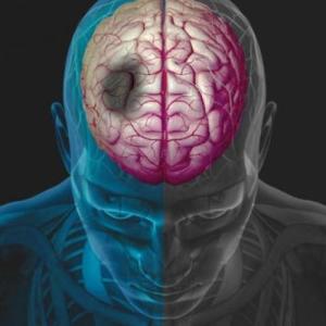 Meta-analysis strengthens case for argatroban use in patients with END after stroke