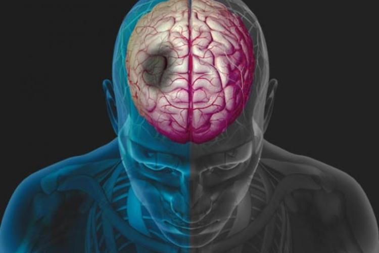 Meta-analysis strengthens case for argatroban use in patients with END after stroke