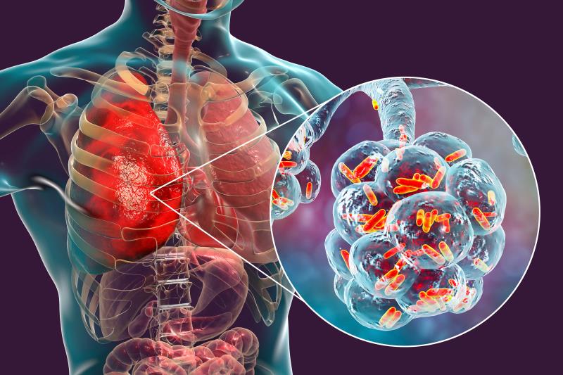 The recurrence rate of organizing <a href="https://specialty.mims.com/pneumonia%20-%20community-acquired/treatment">pneumonia