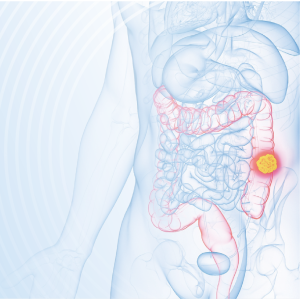 Encorafenib plus cetuximab for treatment of BRAFV600E-mutant metastatic colorectal cancer: A case study