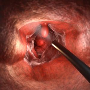 Computer-aided system improves lesion detection rate during colonoscopy