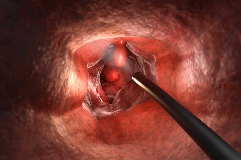 Computer-aided system improves lesion detection rate during colonoscopy