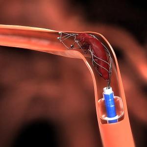 Endovascular therapy complications not dictated by timing of administration