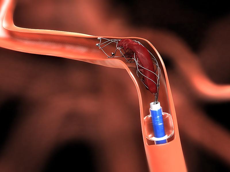 Endovascular therapy complications not dictated by timing of administration