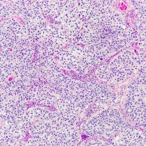 Add-on cabozantinib confers survival benefit in advanced renal-cell carcinoma with caveat