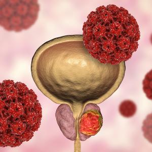 Cabozantinib plus ADT an effective combo in hormone-naïve metastatic prostate cancer