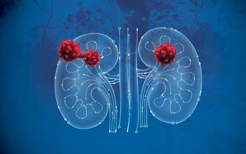 ESMO 2024 Kidney Cancer Puzzles: From Insights to Progress