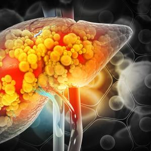 NAFLD progression may raise ESLD risk