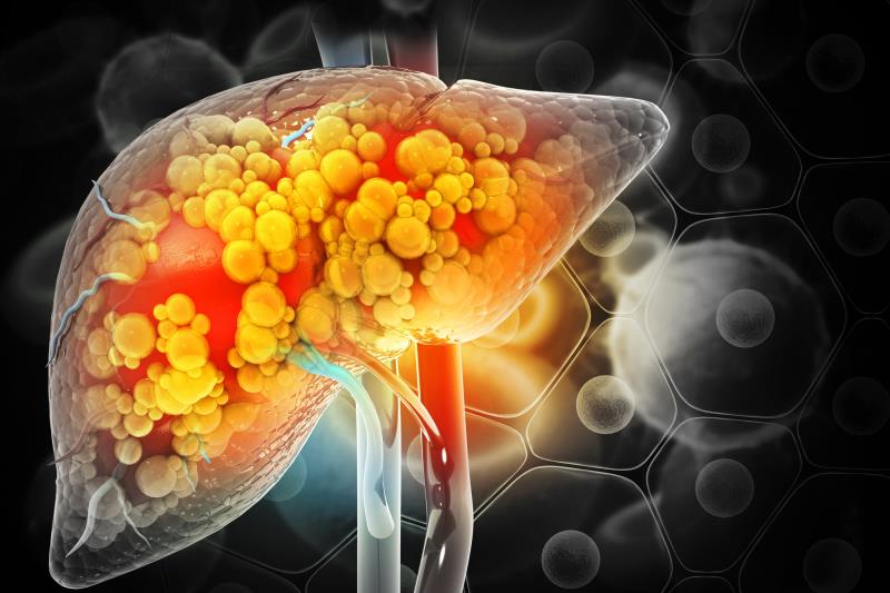 NAFLD progression may raise ESLD risk