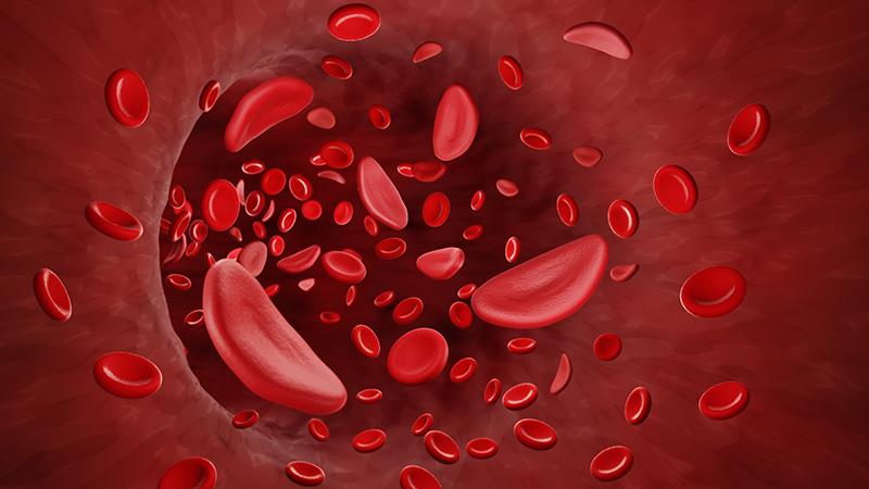 Etavopivat reduces VOCs in patients with sickle cell disease