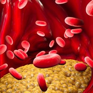 Cholesterol, albumin affect MACE risk in coronary artery disease