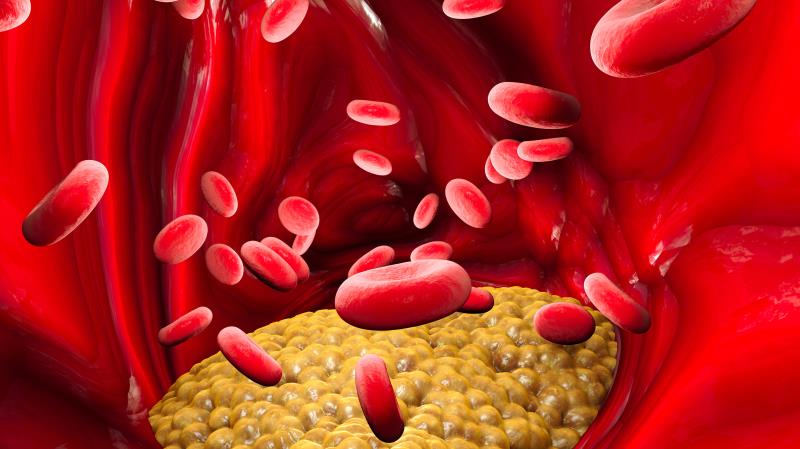 Cholesterol, albumin affect MACE risk in coronary artery disease