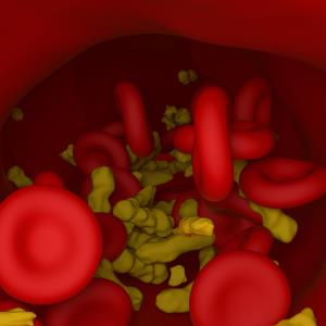 Evinacumab reduces LDL-C levels in homozygous FH