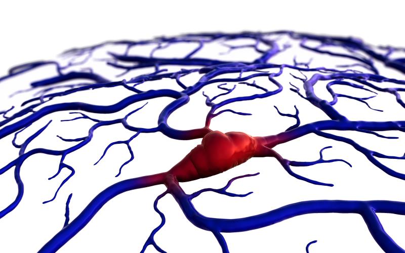 Endovascular treatment a glimmer of hope for ischaemic stroke from basilar artery occlusion