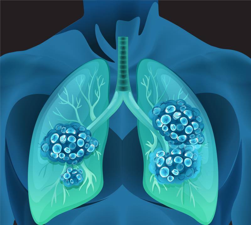 eXalt3: Ensartinib trumps crizotinib in ALK+ NSCLC