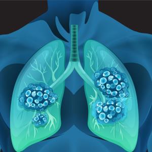 Reduced TKI dose on par with standard dose for NSCLC