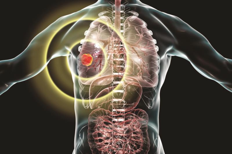 NSCLC with EGFR exon 20 mutations: Twice-daily poziotinib clinically active, reduces AEs