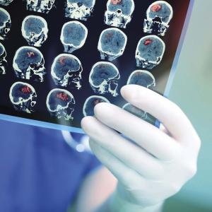 Nelonemdaz safe but fails to improve outcomes in stroke