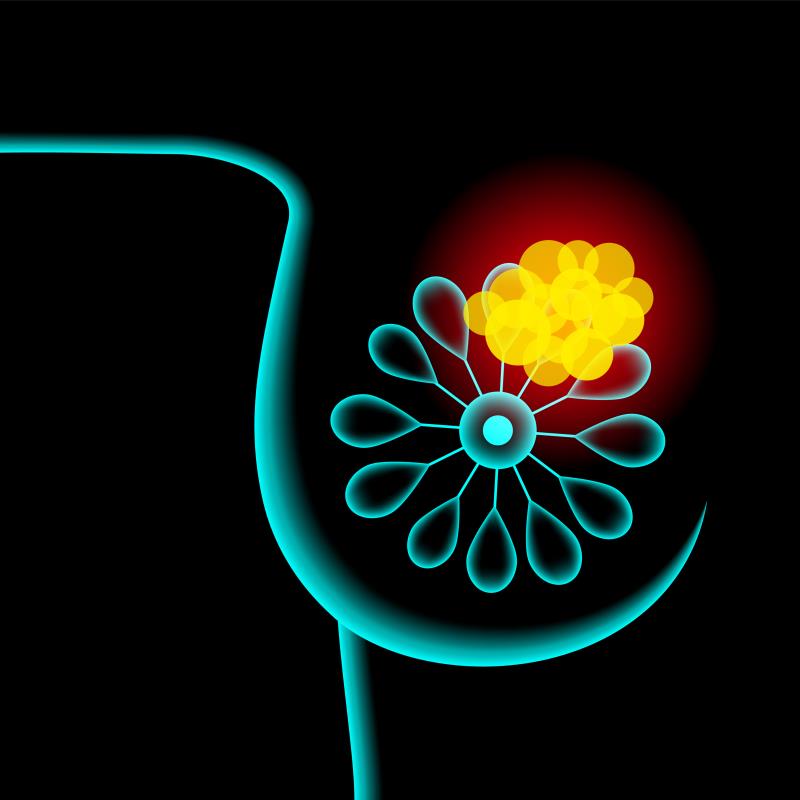 Minimal access nipple-sparing mastectomy a viable breast cancer treatment option