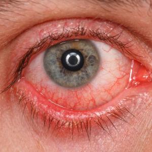 Eye inflammation may occur in patients on subretinal gene therapy