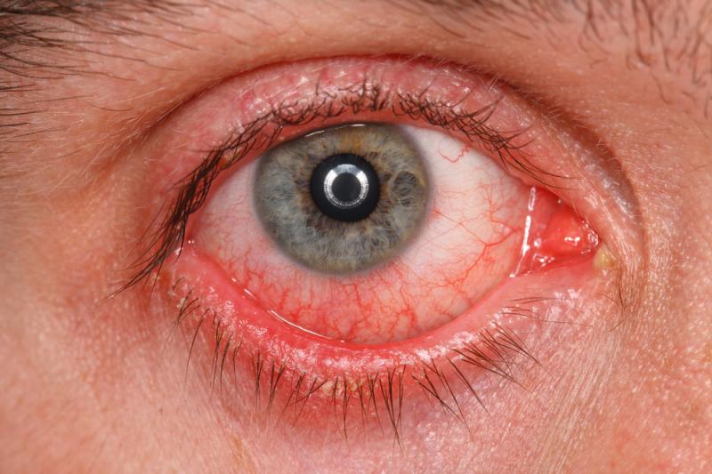 Eye inflammation may occur in patients on subretinal gene therapy