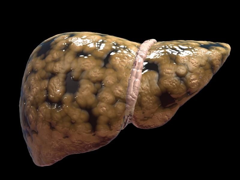 Fatty liver more common in MAFLD than NAFLD